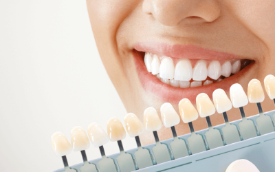 Creative Smiles | Professional Teeth Whitening vs Store-Bought Kits Professional Teeth Whitening vs Store-Bought Kits